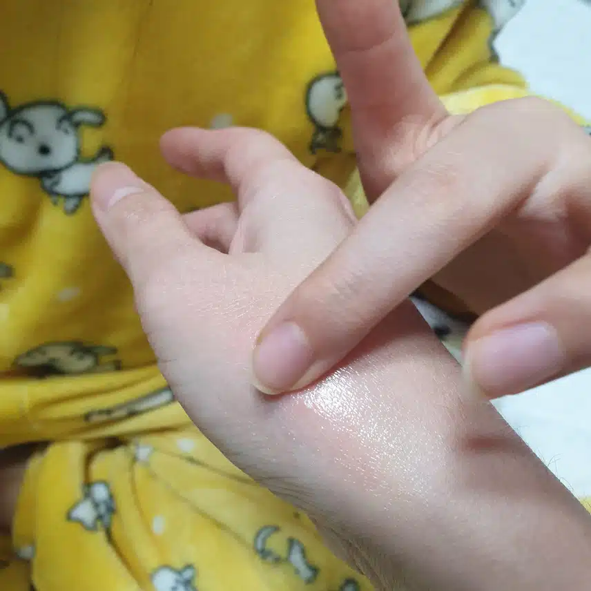 결국 손이 트네요 ㅠ