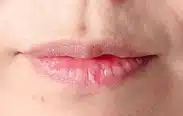 캐시닥 이벤트로 입술필러