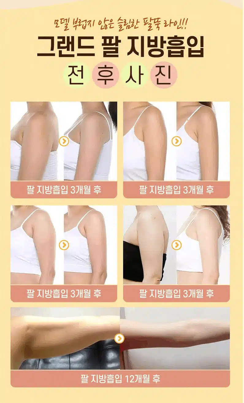 지방흡입 가격 비싸지 않네요~ 생각보다 저렴한 거 같아요