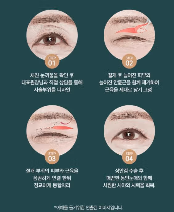 안검하수수술 부모님 해드리려는데, 이곳 어떤가요?