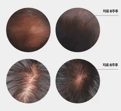 원형탈모 의심.... 병원을 가야하겠죠...?