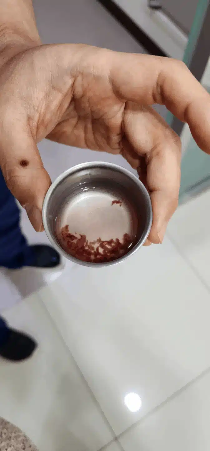 대구 여성아이병원에서 자궁용종  제거수술하고왔어요 !