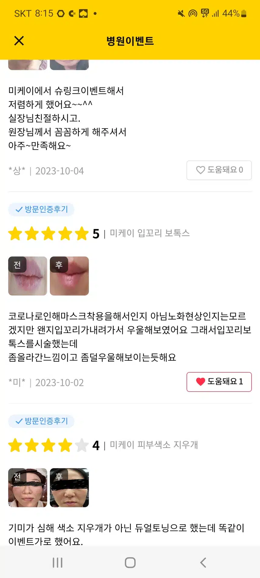 미케이의원 입꼬리복톡스 추천합니다