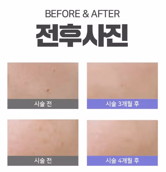 여드름 색소침착 하면 어떤걸로 해야할까요?  레이지 추천좀요! 