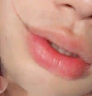 화상 입었을 때 1도 얼굴 화상 응급처치 후시딘 치료 후기