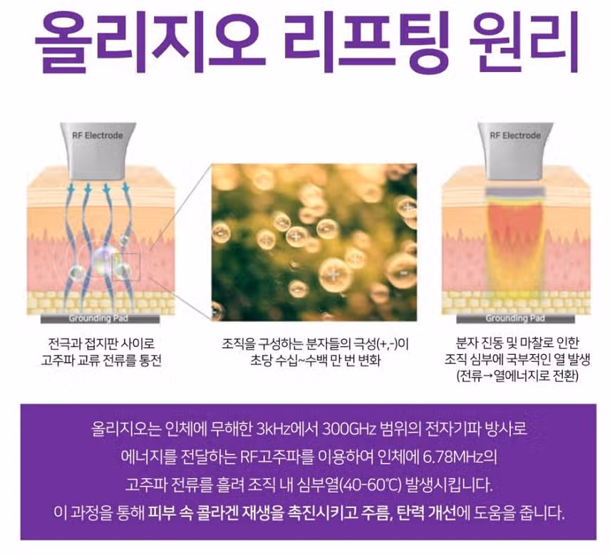 [탑리뷰어5기] 올리지오 시술 받고 싶어요.