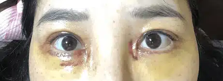 안검하수 수술 전후 : 상안검 수술 8개월차 후기