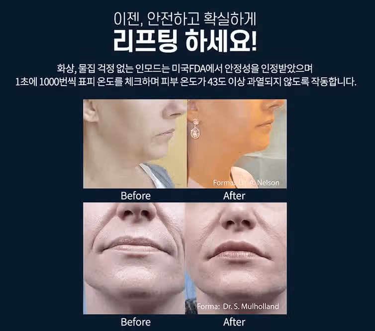 인모드리프팅 후기! 피부 리프팅 미쳤다 ! 
