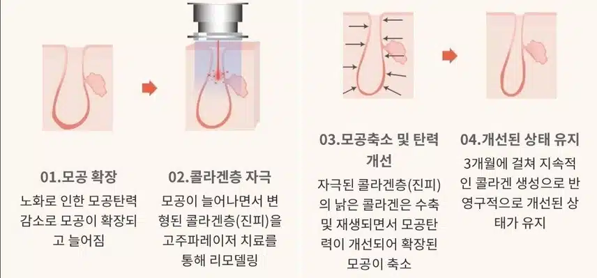 [탑리뷰어5기]모공축소 아토스레이저 받고싶어요~