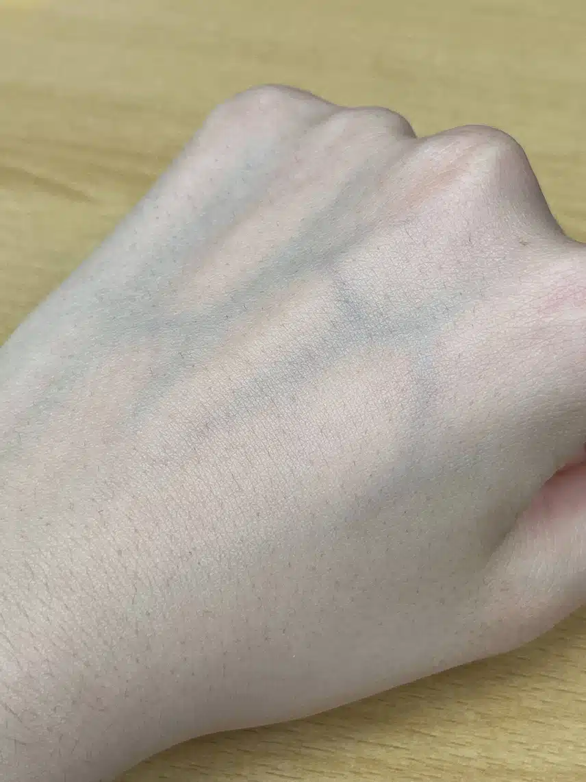 [탑리뷰어5기] 레이저 제모 시술 후기