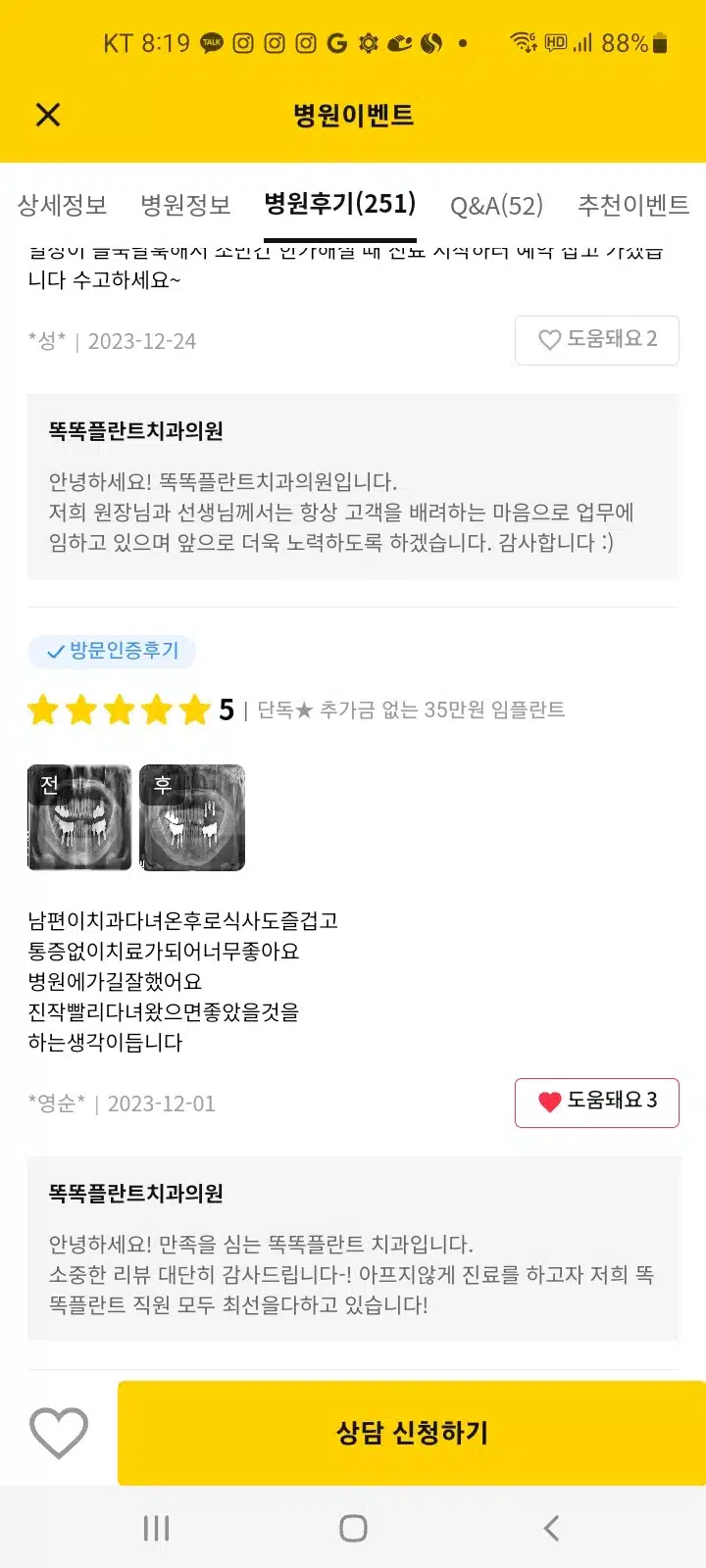 똑똑플란트치과의원 35만원 임플란트 후기 도움이 되었습니다 
