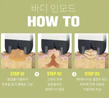 인모드리프팅으로 군살 정리 가능????