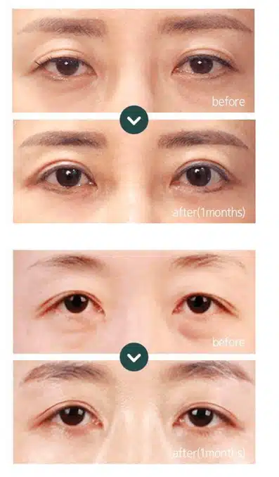 상안검 하안검 상담 받고 싶어요!!!