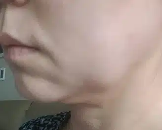 [탑리뷰어5기] 볼살 처짐과 이중턱에 효과있는 리프팅 시술(인모드) 받고 싶어요 ~~