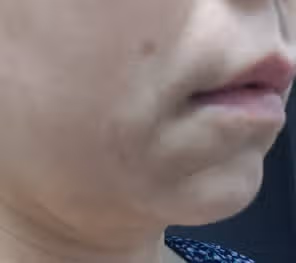 [탑리뷰어5기] 볼살 처짐과 이중턱에 효과있는 리프팅 시술(인모드) 받고 싶어요 ~~