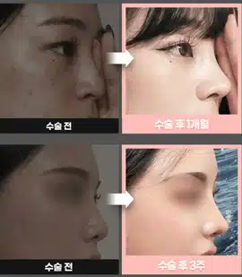 기능코 성형은 실비 보험 처리될까요?