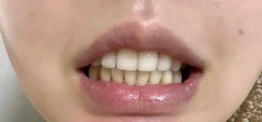 치아교정과 미백이 궁금해요
