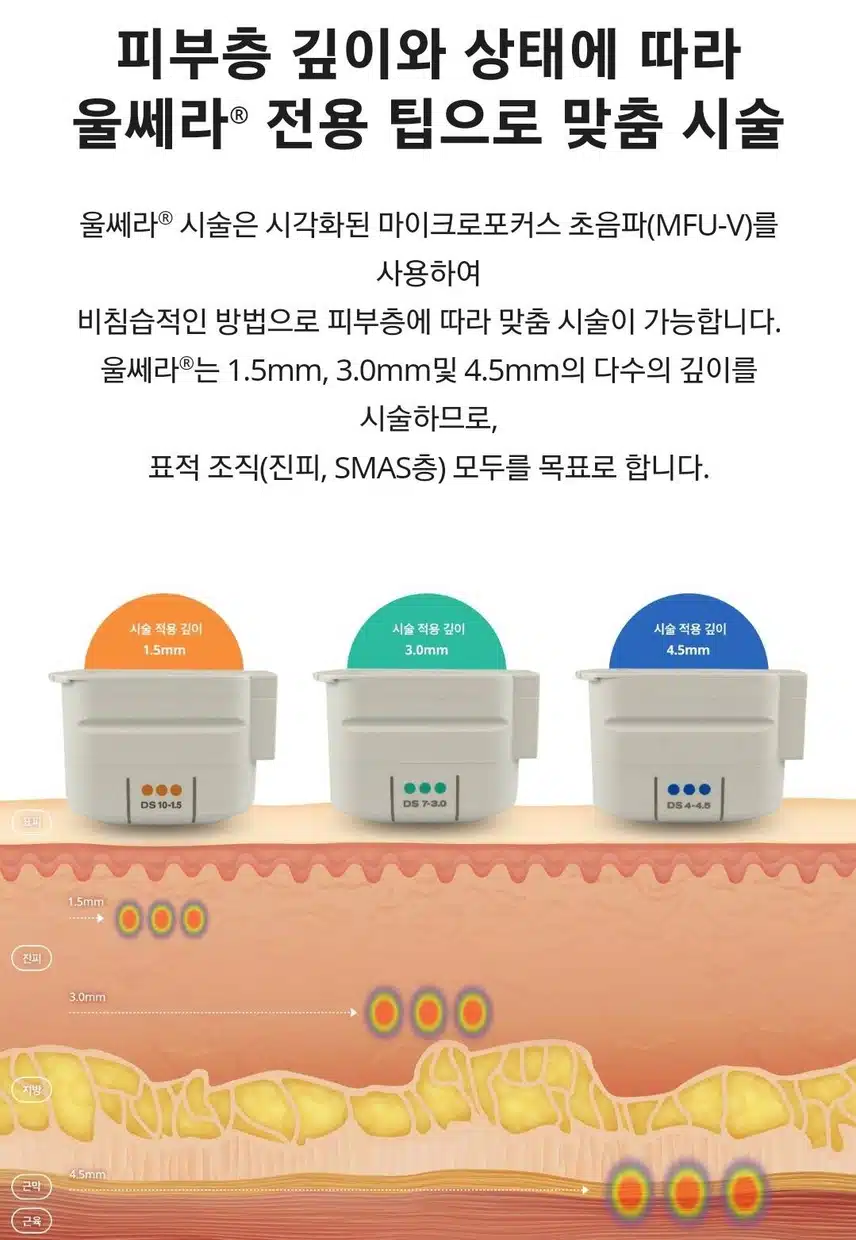 울쎄라 시술받고싶어서 알아봤어요😃