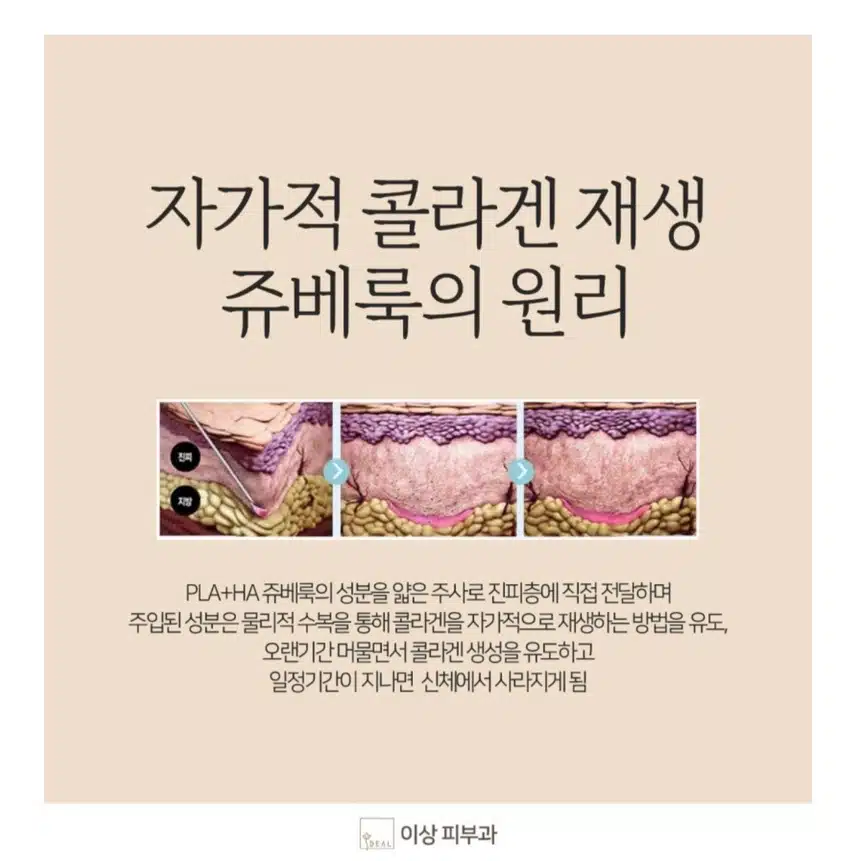[탑리뷰어5기]모공 잔주름 시술에 효과 좋을 것 같은 쥬베룩