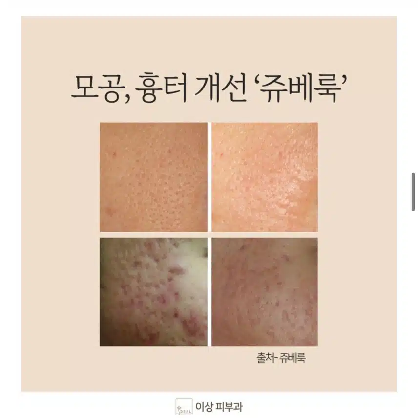 [탑리뷰어5기]모공 잔주름 시술에 효과 좋을 것 같은 쥬베룩