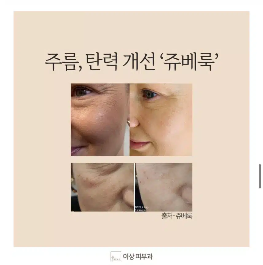 [탑리뷰어5기]모공 잔주름 시술에 효과 좋을 것 같은 쥬베룩