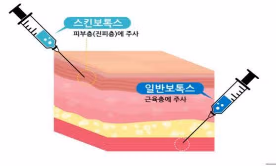 (탑리뷰어5기)스킨보톡스 시술 받아보고 싶어요