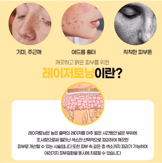 [탑리뷰어 5기] 레이저토닝으로 기미 없애고 싶어요