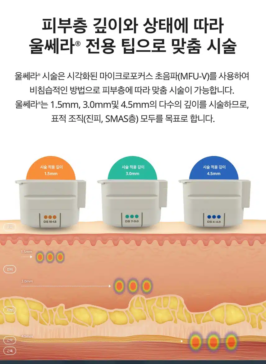 [탑리뷰어5기] 내가 받고 싶은 시술 '울쎄라'