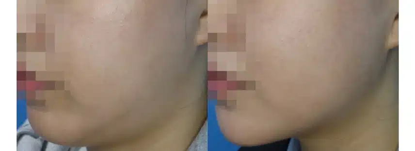 [탑리뷰어5기] 내가 받고 싶은 시술 '울쎄라'