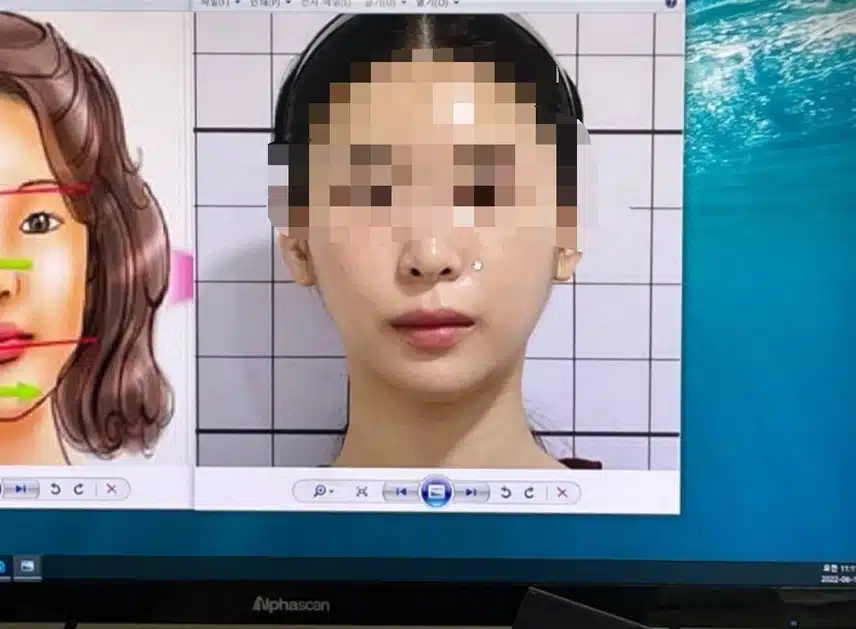안면비대칭 한의원 치료햇어요