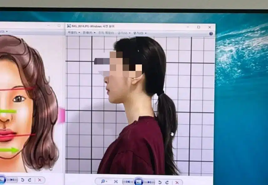 안면비대칭 한의원 치료햇어요
