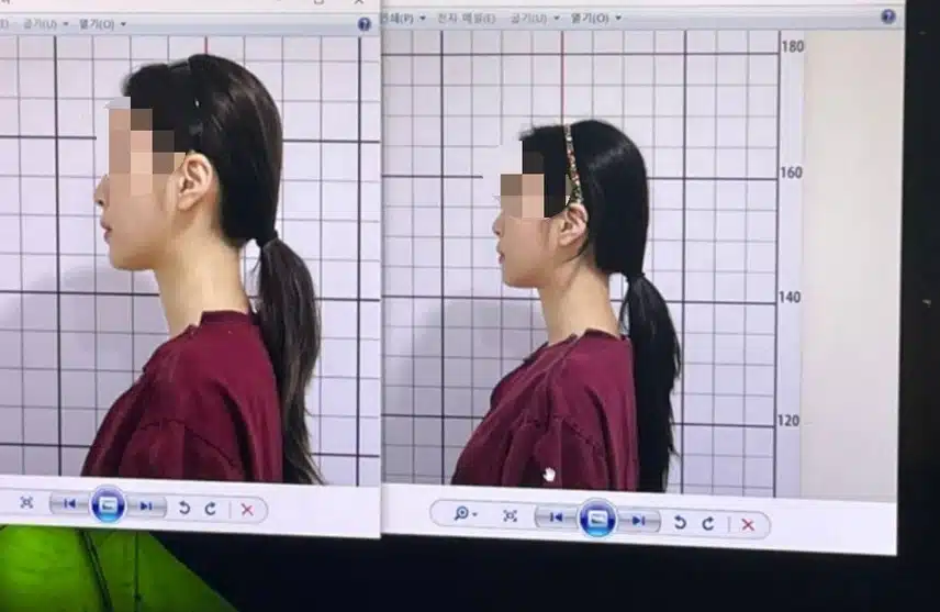 안면비대칭 한의원 치료햇어요
