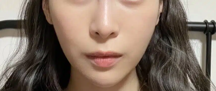 안면비대칭 한의원 치료햇어요