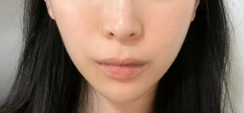 안면비대칭 한의원 치료햇어요