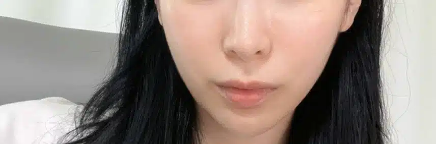 안면비대칭 한의원 치료햇어요