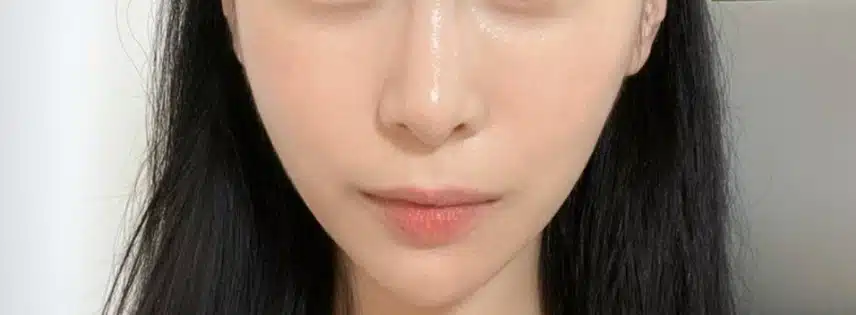 안면비대칭 한의원 치료햇어요