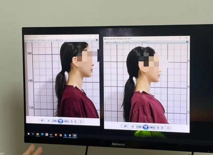 안면비대칭 한의원 치료햇어요