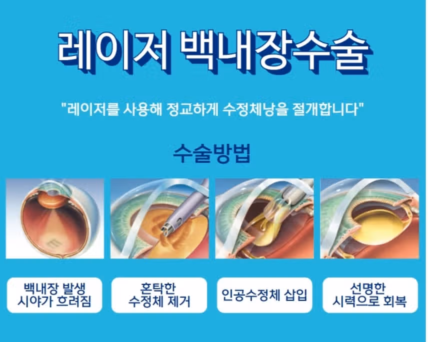 백내장 수술전문안과 - 대전 유성구 서울안과 