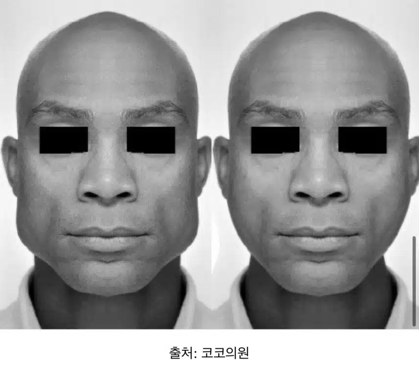 [탑리뷰어 5기] 사각턱 보톡스 맞아보고 싶어요