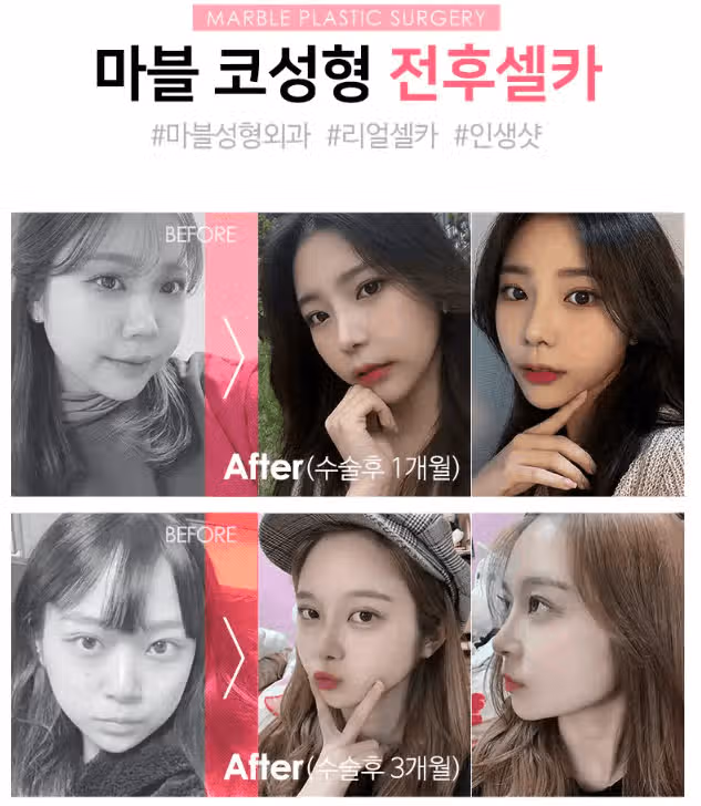 코수술 후기 알고 싶어요... 잘 아시는 분들 알려주세요!! 
