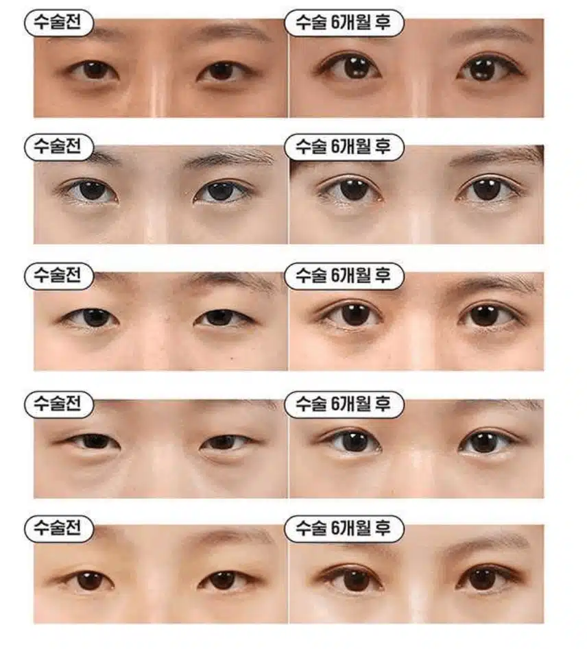 눈 지방이식 해보려고 하는데 병원 추천 부탁 드려요!~! 