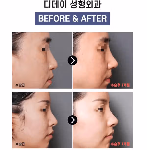 작은코 성형 수술 해보고 싶어요 :) 좋은 병원 알려주세요~~