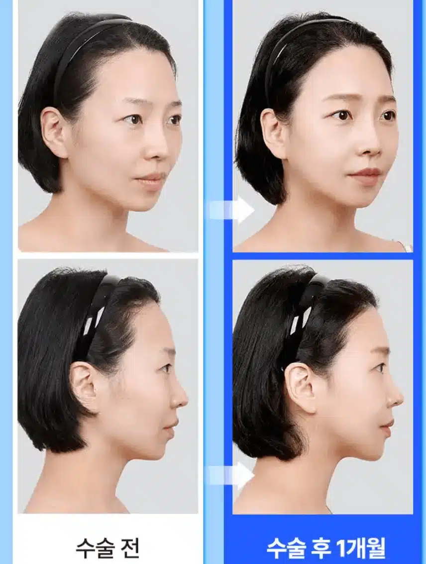 실리프팅 비용 알아보는 중이에요. 가성비 좋은 곳 알려주세요 ㅎㅎ 