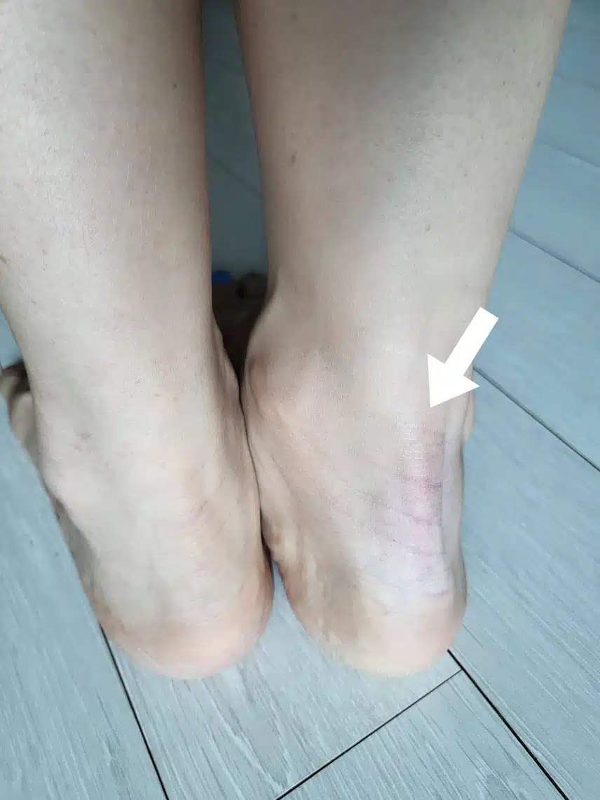 한방 침치료로 아킬레스건 치료가능한가요?