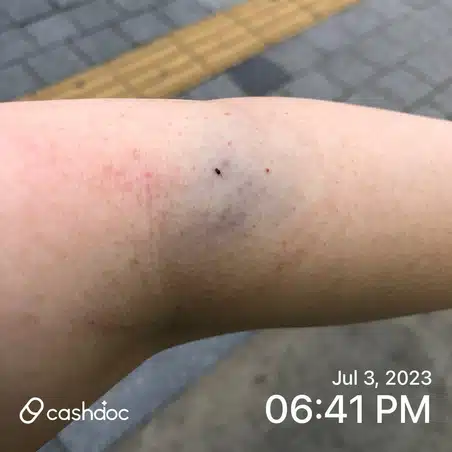 한의원에서 침맞거나 습부황을 떴을때 