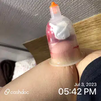 한의원에서 침맞거나 습부황을 떴을때 