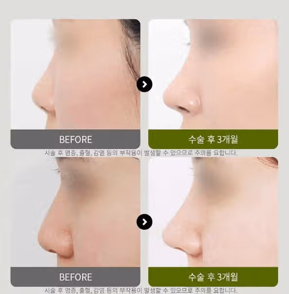 코수술가격 얼마정도면 적당한 거죠? 