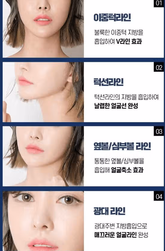 볼살지방흡입 해볼 병원 구합니다 :) 급구 급구 ㅎㅎ