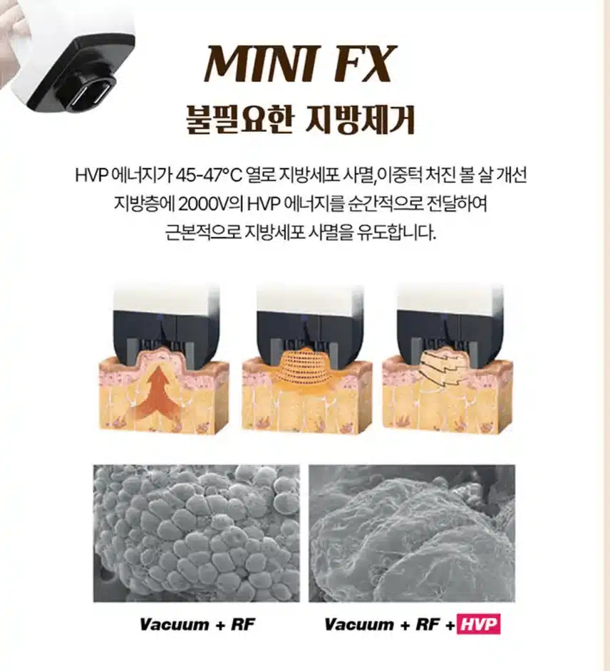 인모드 효과시기 언제쯤 나타나나요? 