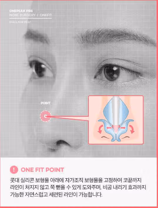 코성형술 후기입니다. (완전 좋았어요)